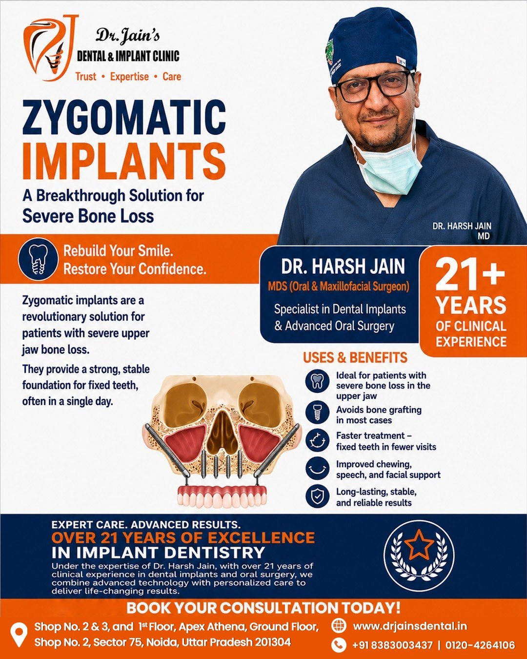 Zygomatic Implants 